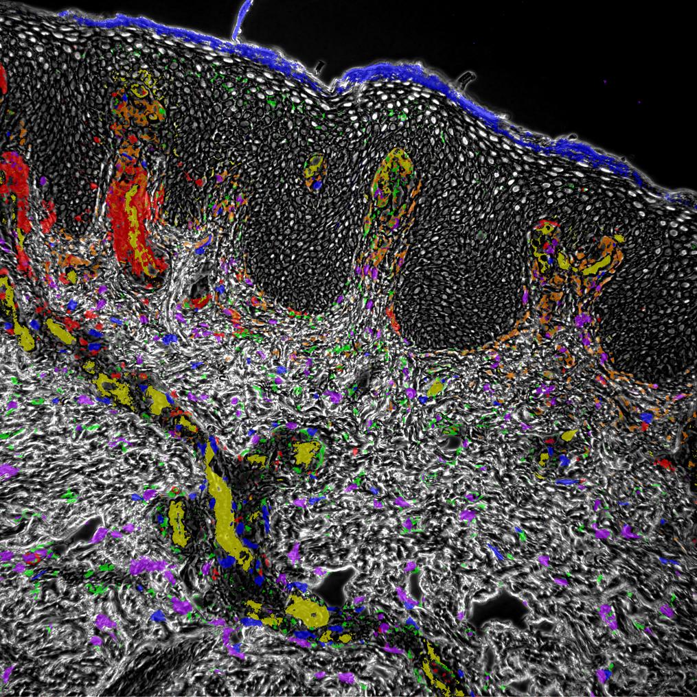 FactorXIII Subunit A